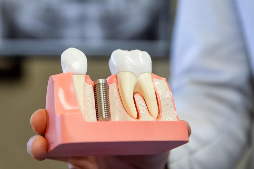 A dental implant model being explained to a patient in our Brooklyn office