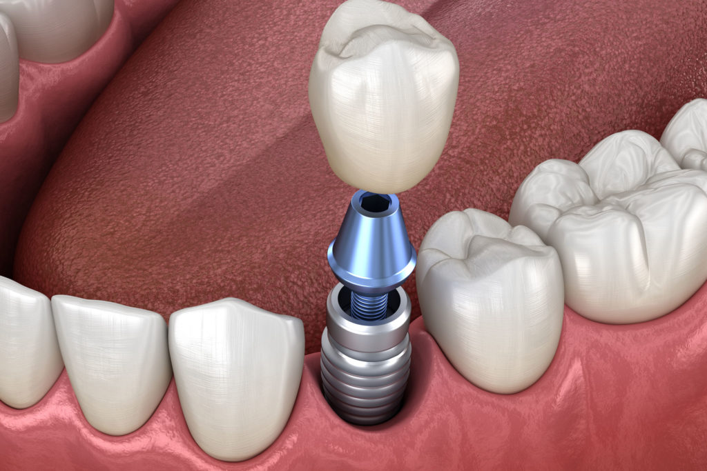 dental implant model Brooklyn, NY