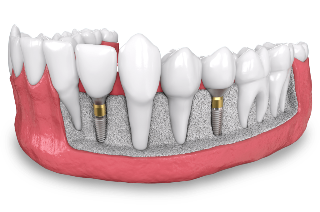 dental implant model Brooklyn, NY