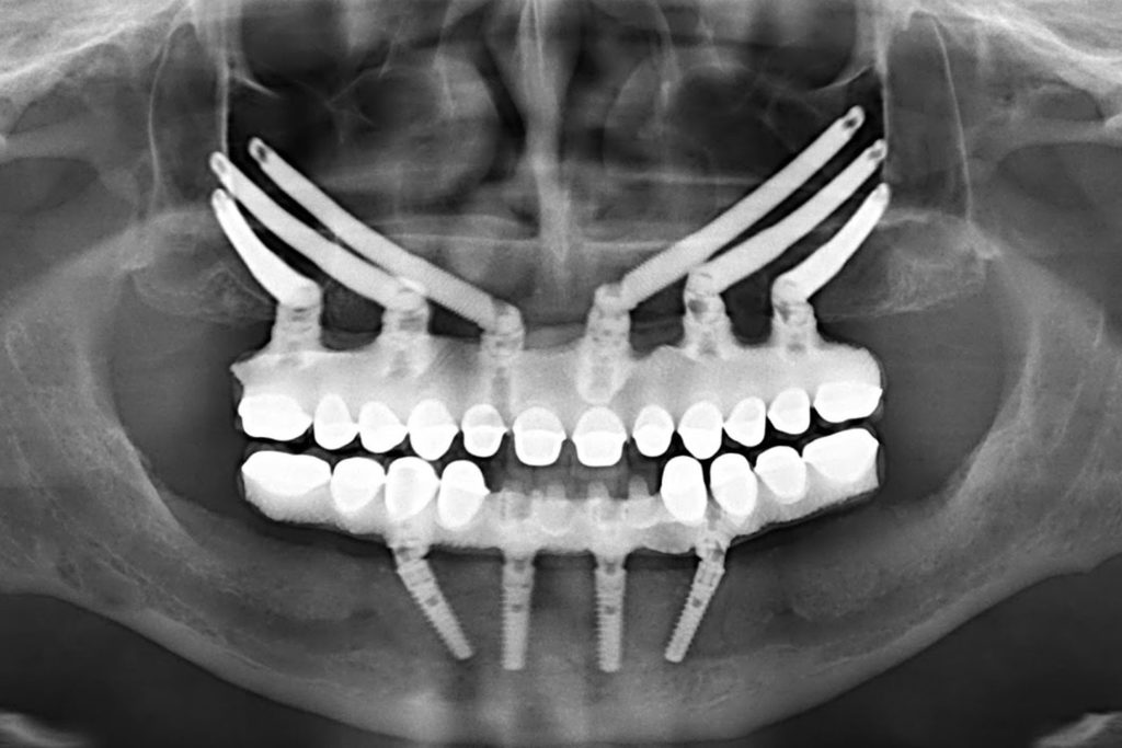 zygomatic dental implants Brooklyn, NY