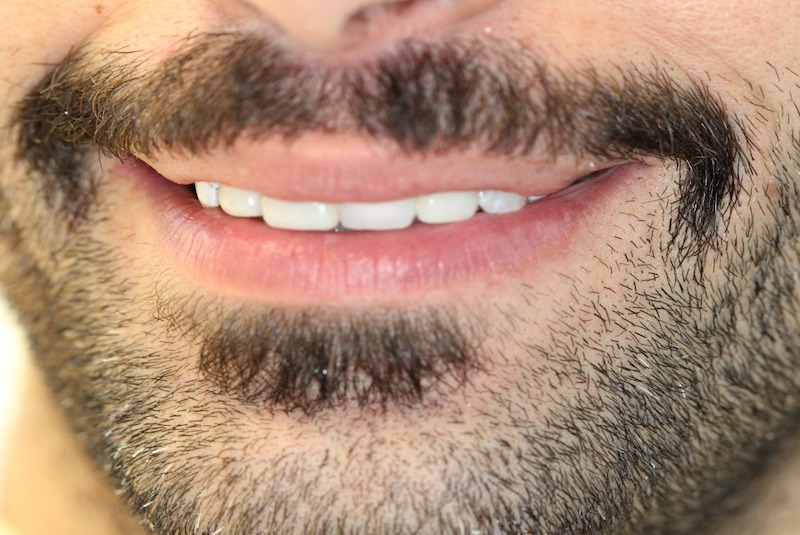 veneers after