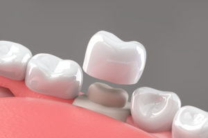 a single dental crown model.